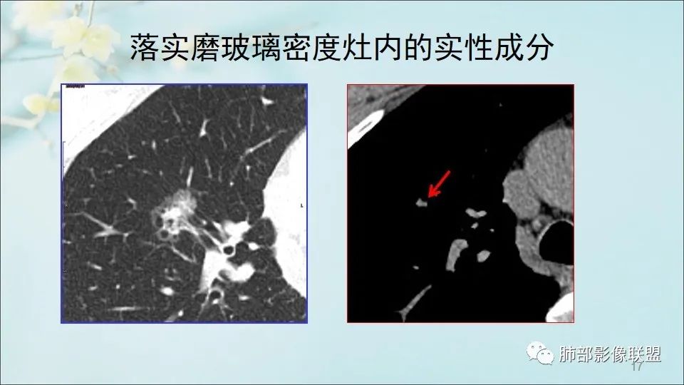 【PPT】重视针对肺GGO的战略转移