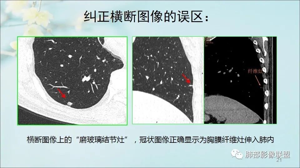 【PPT】重视针对肺GGO的战略转移