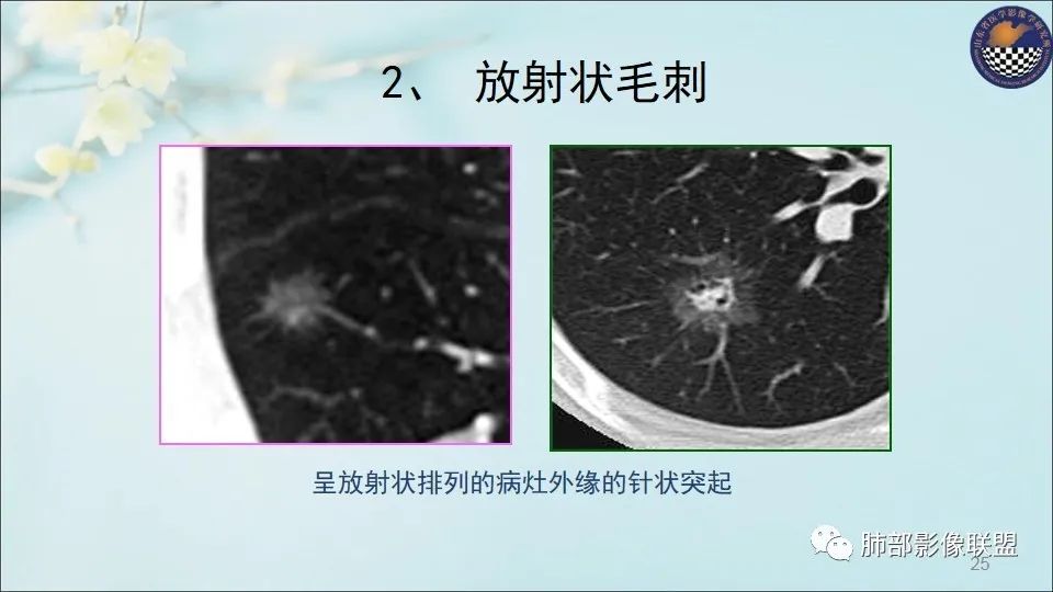 【PPT】重视针对肺GGO的战略转移