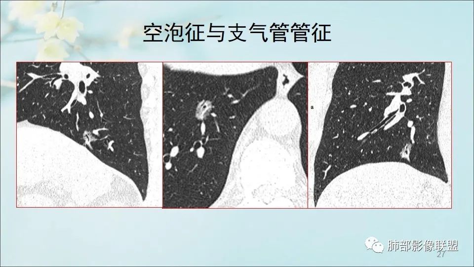 【PPT】重视针对肺GGO的战略转移
