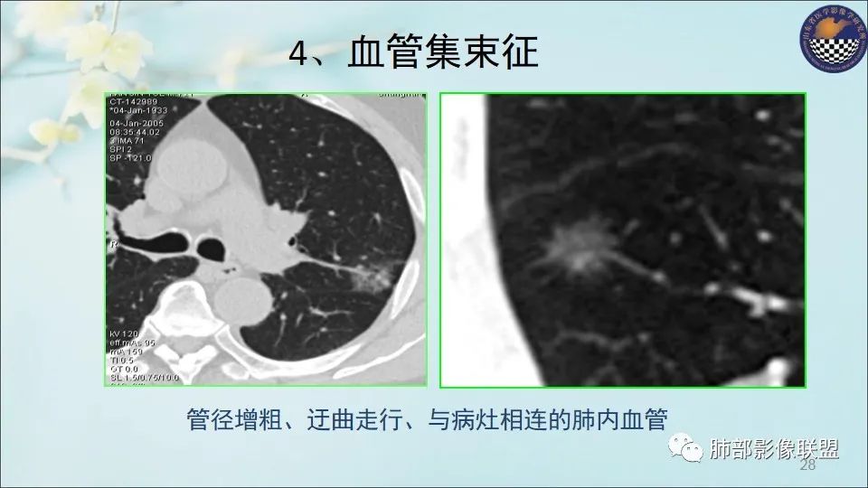 【PPT】重视针对肺GGO的战略转移