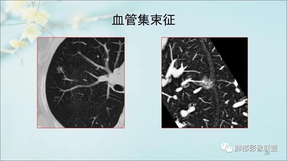 【PPT】重视针对肺GGO的战略转移
