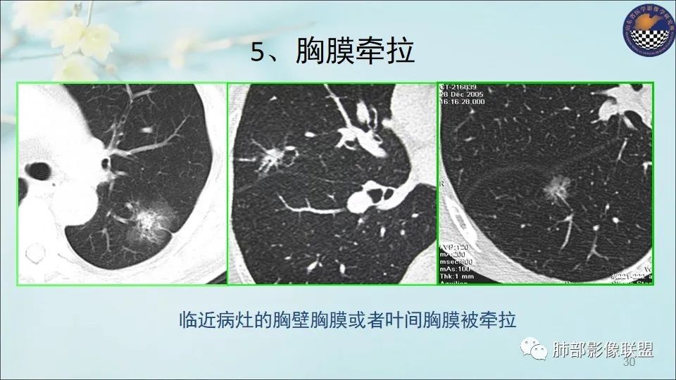 【PPT】重视针对肺GGO的战略转移