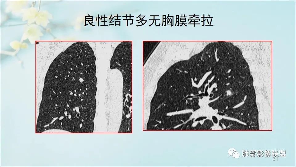 【PPT】重视针对肺GGO的战略转移