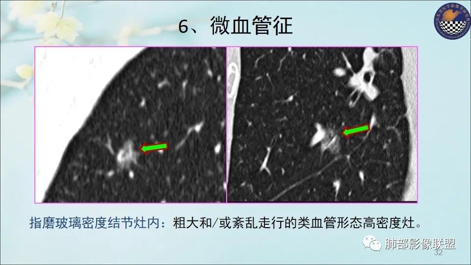 【PPT】重视针对肺GGO的战略转移