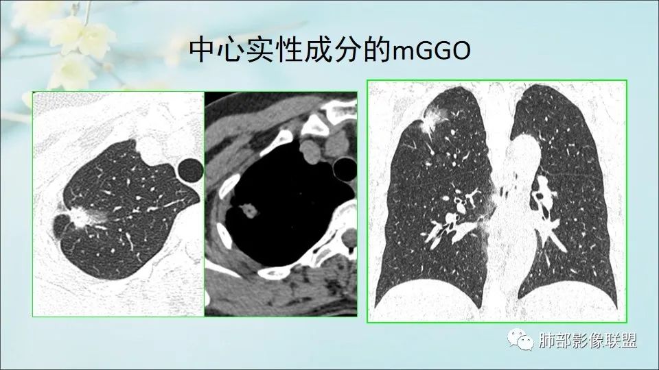 【PPT】重视针对肺GGO的战略转移