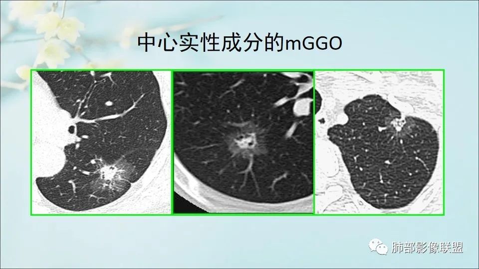 【PPT】重视针对肺GGO的战略转移