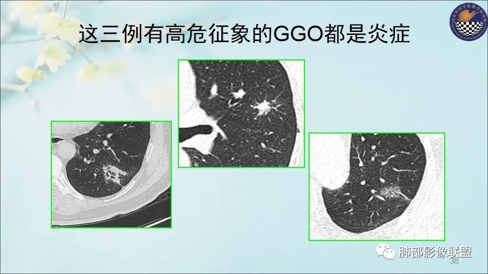 【PPT】重视针对肺GGO的战略转移