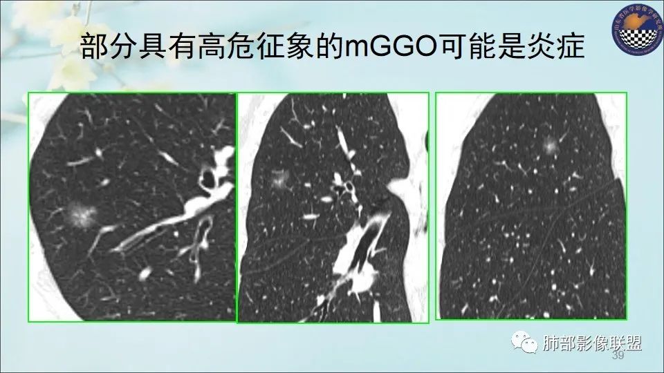 【PPT】重视针对肺GGO的战略转移