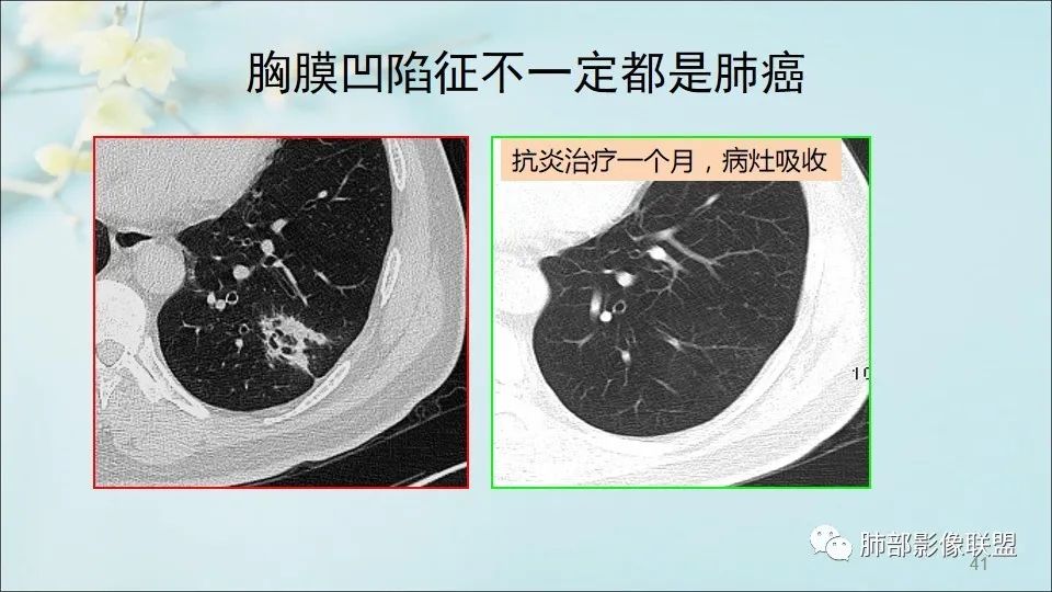 【PPT】重视针对肺GGO的战略转移