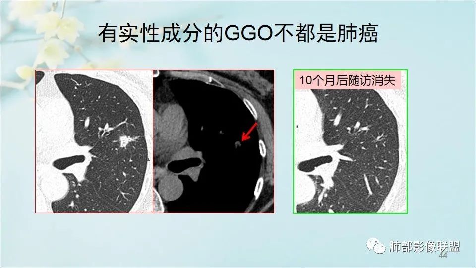 【PPT】重视针对肺GGO的战略转移
