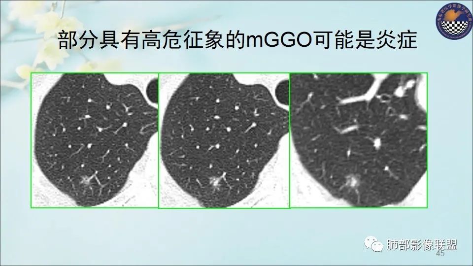 【PPT】重视针对肺GGO的战略转移