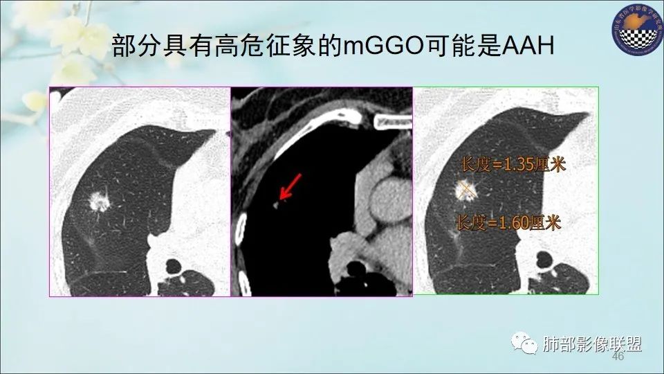 【PPT】重视针对肺GGO的战略转移