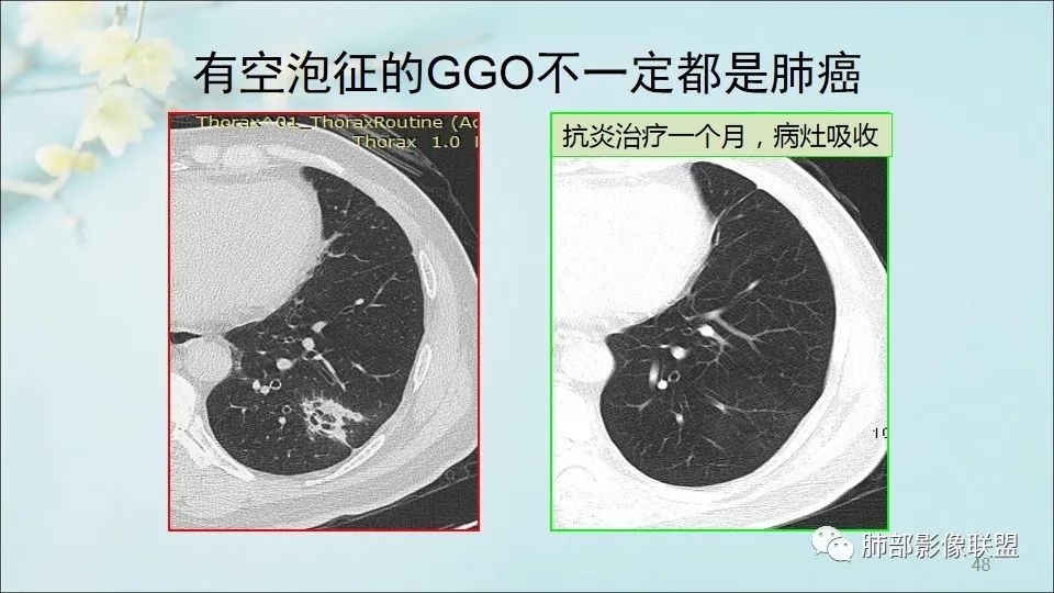 【PPT】重视针对肺GGO的战略转移