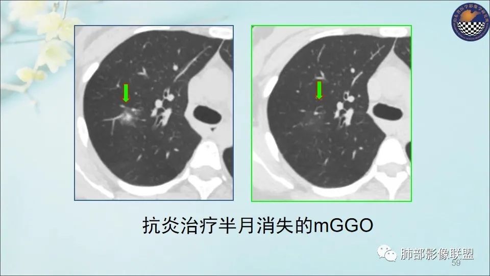 【PPT】重视针对肺GGO的战略转移