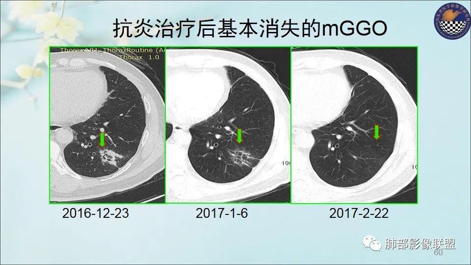 【PPT】重视针对肺GGO的战略转移