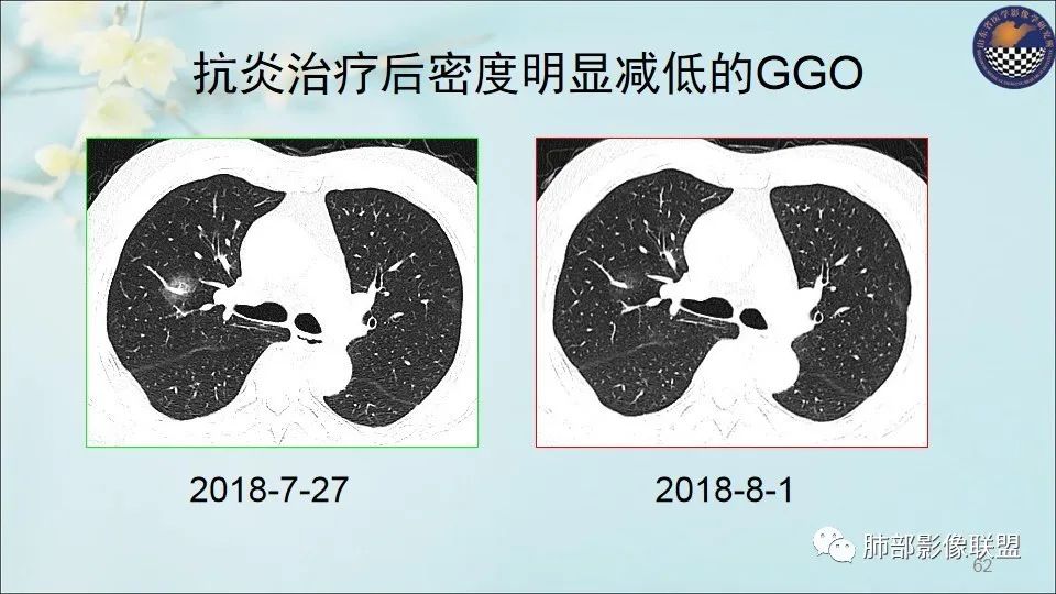 【PPT】重视针对肺GGO的战略转移