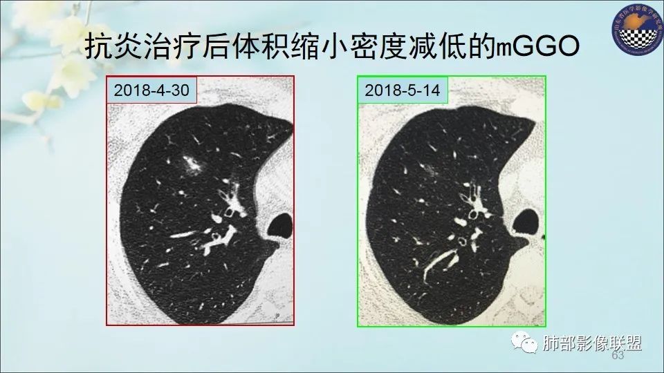 【PPT】重视针对肺GGO的战略转移