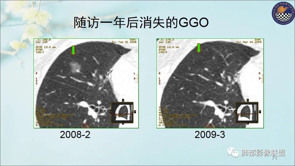 【PPT】重视针对肺GGO的战略转移