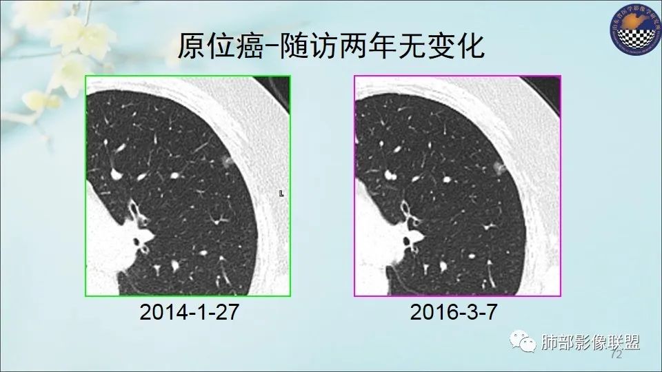 【PPT】重视针对肺GGO的战略转移
