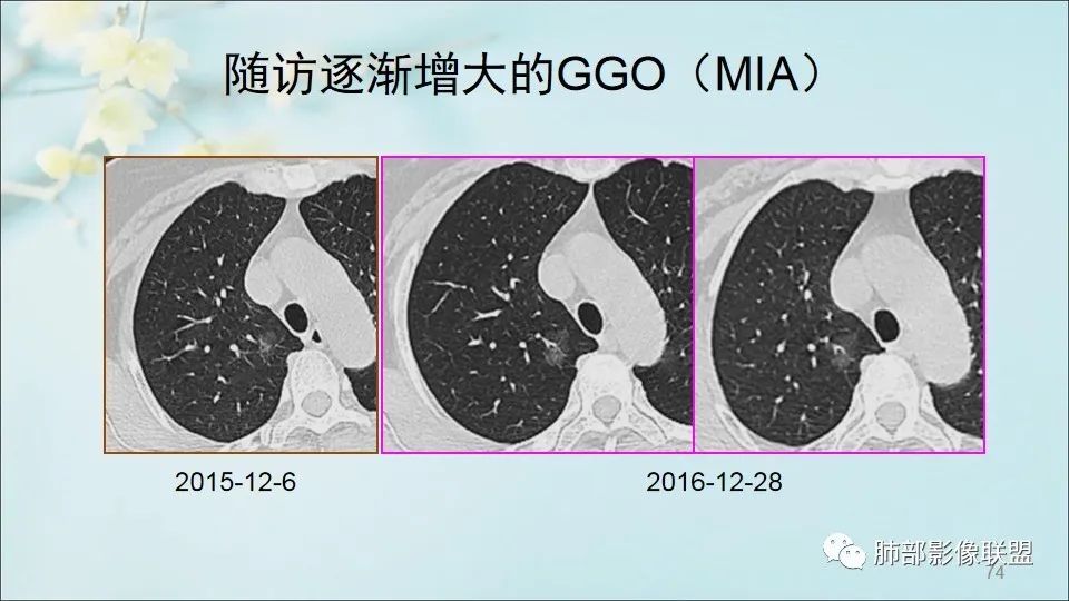 【PPT】重视针对肺GGO的战略转移