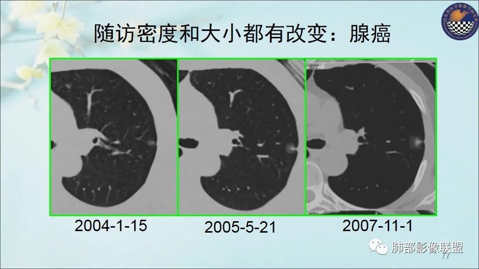 【PPT】重视针对肺GGO的战略转移
