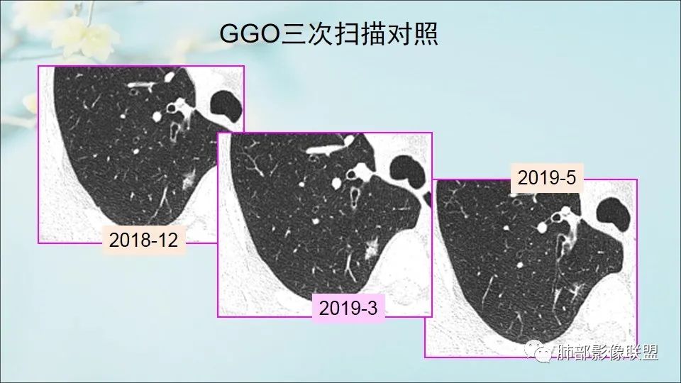 【PPT】重视针对肺GGO的战略转移