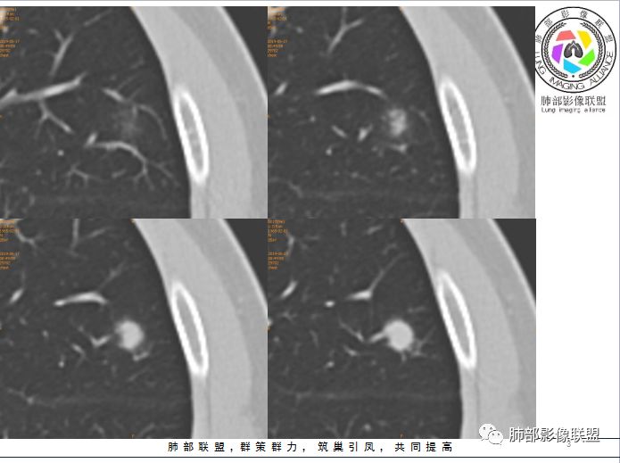 【病例】隐球菌1例CT影像讨论 【病例】隐球菌1例CT影像讨论