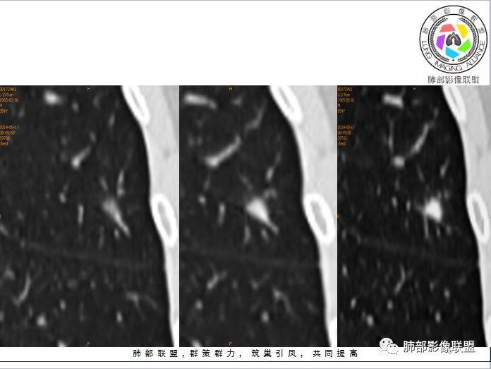 【病例】隐球菌1例CT影像讨论 【病例】隐球菌1例CT影像讨论