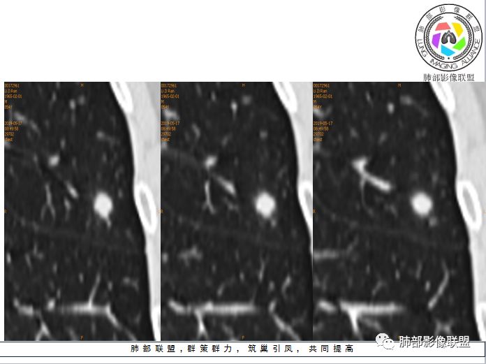 【病例】隐球菌1例CT影像讨论 【病例】隐球菌1例CT影像讨论