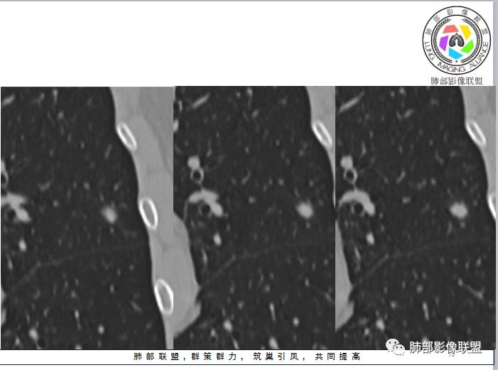 【病例】隐球菌1例CT影像讨论 【病例】隐球菌1例CT影像讨论