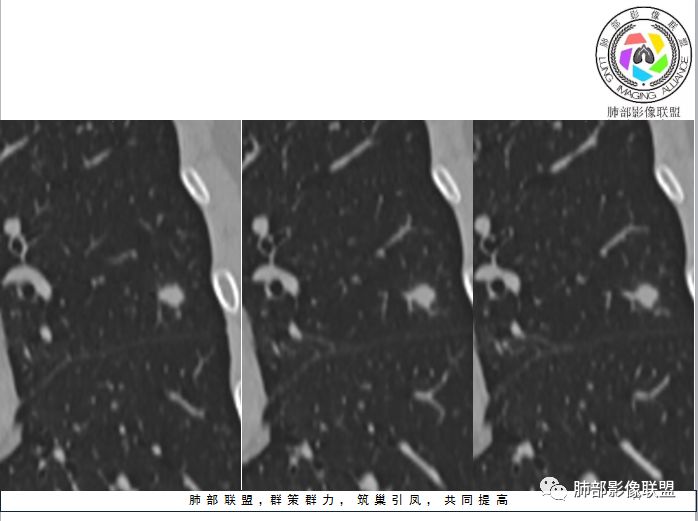 【病例】隐球菌1例CT影像讨论 【病例】隐球菌1例CT影像讨论