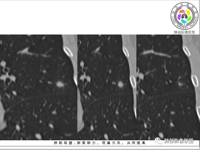 【病例】隐球菌1例CT影像讨论 【病例】隐球菌1例CT影像讨论