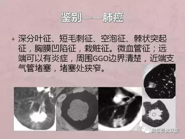 【病例】隐球菌1例CT影像讨论 【病例】隐球菌1例CT影像讨论