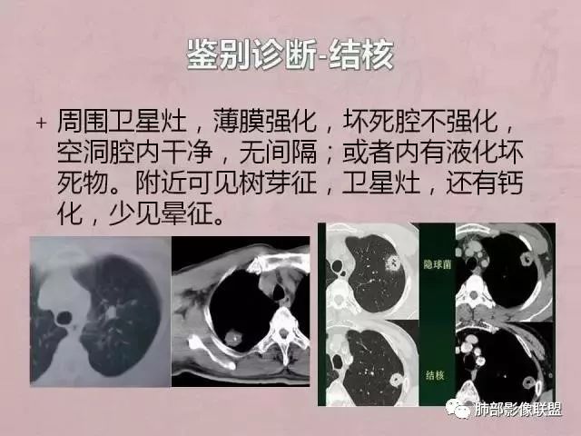 【病例】隐球菌1例CT影像讨论 【病例】隐球菌1例CT影像讨论