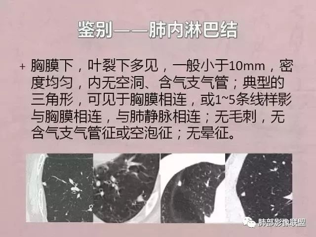 【病例】隐球菌1例CT影像讨论 【病例】隐球菌1例CT影像讨论