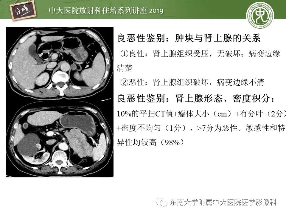 【PPT】肾上腺病变临床与影像思路分析