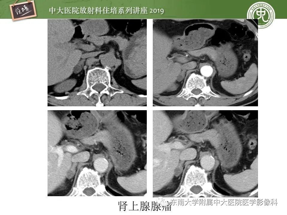 【PPT】肾上腺病变临床与影像思路分析
