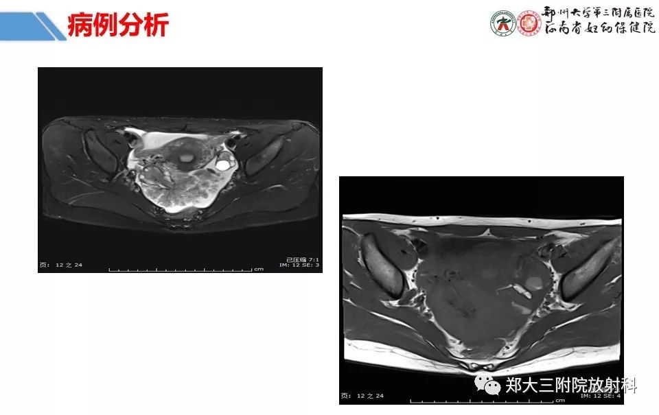 【PPT】卵巢肿瘤的影像诊断思路