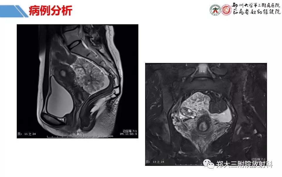 【PPT】卵巢肿瘤的影像诊断思路
