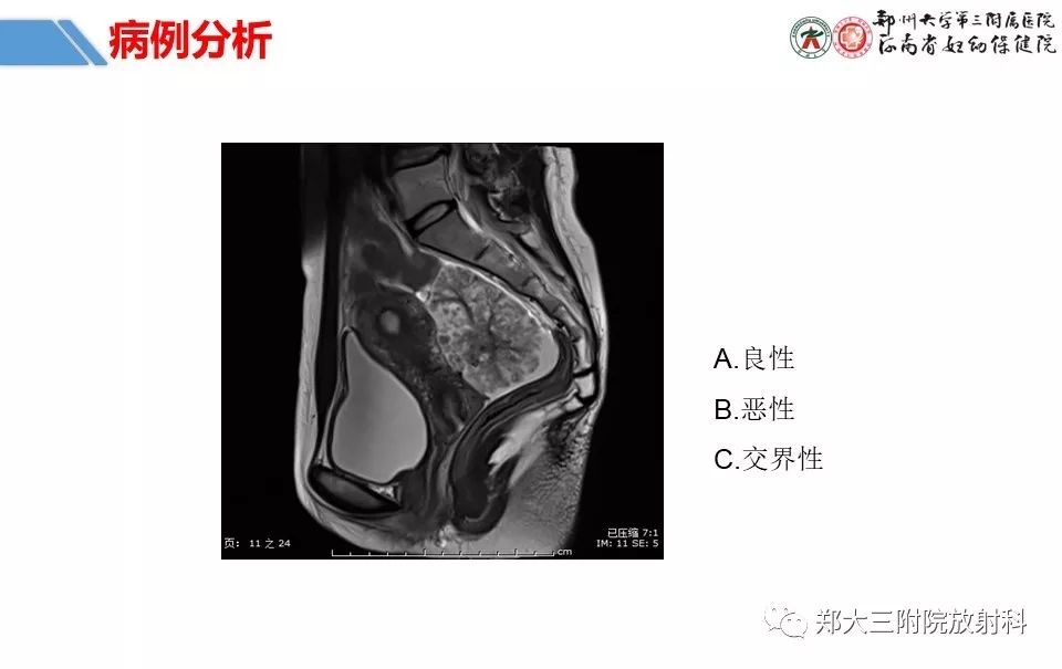 【PPT】卵巢肿瘤的影像诊断思路