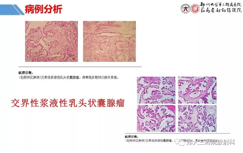 【PPT】卵巢肿瘤的影像诊断思路