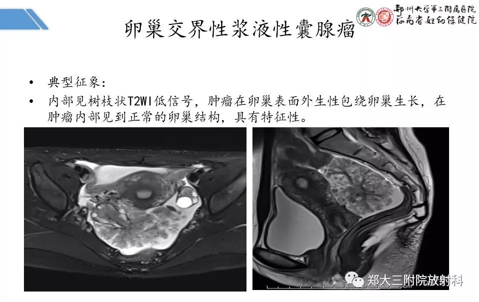 【PPT】卵巢肿瘤的影像诊断思路