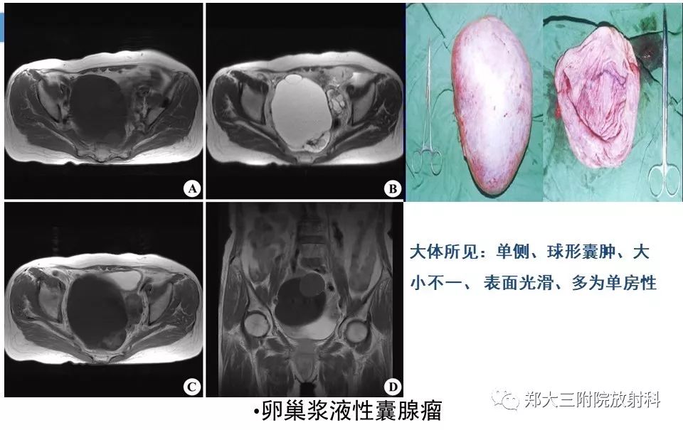 【PPT】卵巢肿瘤的影像诊断思路