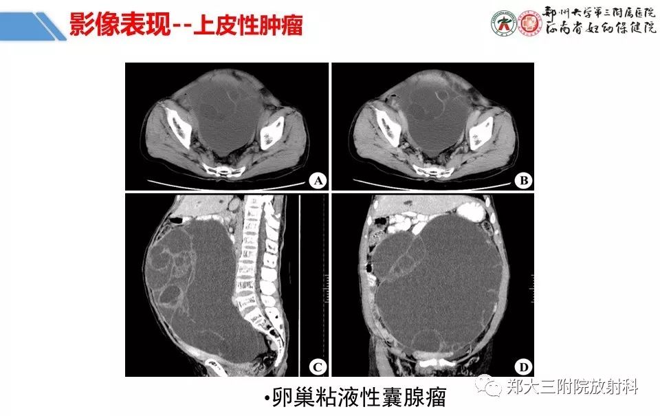 【PPT】卵巢肿瘤的影像诊断思路