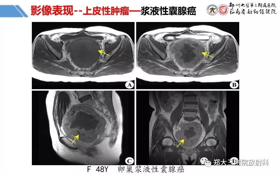 【PPT】卵巢肿瘤的影像诊断思路