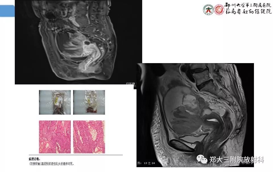 【PPT】卵巢肿瘤的影像诊断思路