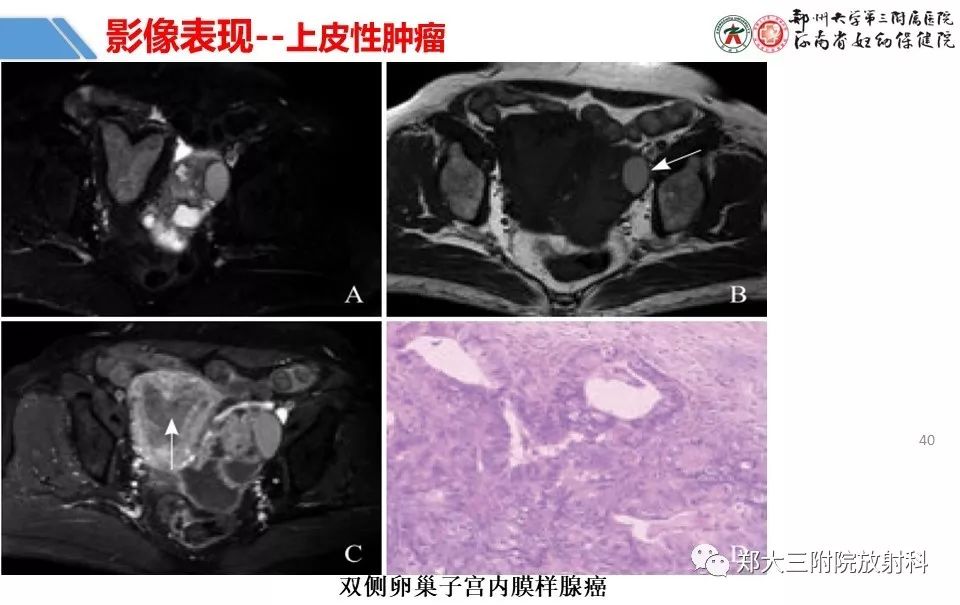 【PPT】卵巢肿瘤的影像诊断思路