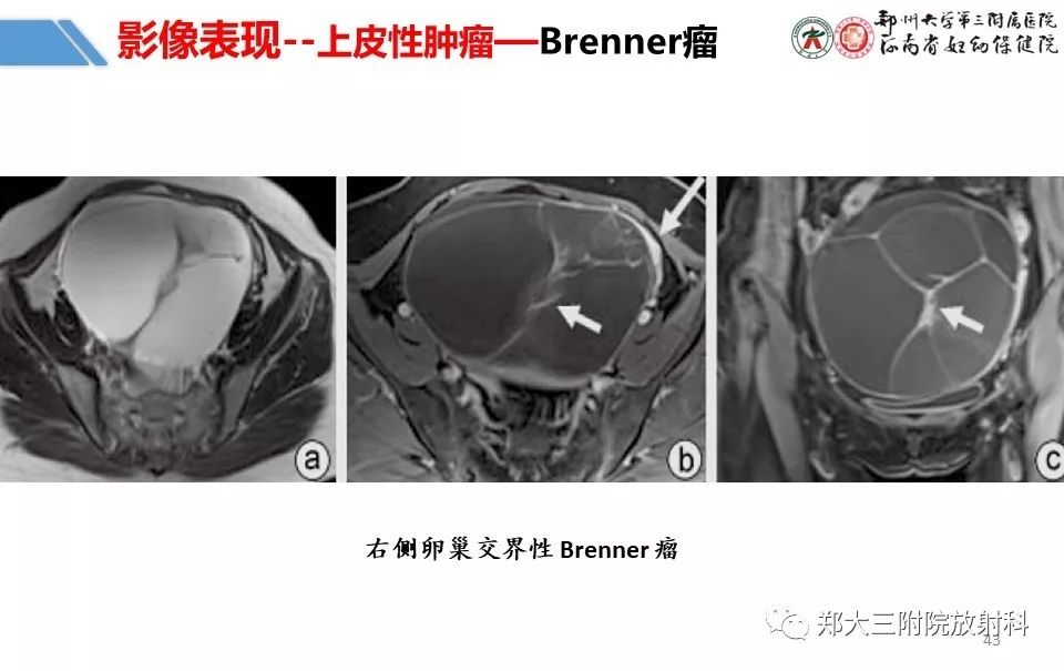 【PPT】卵巢肿瘤的影像诊断思路