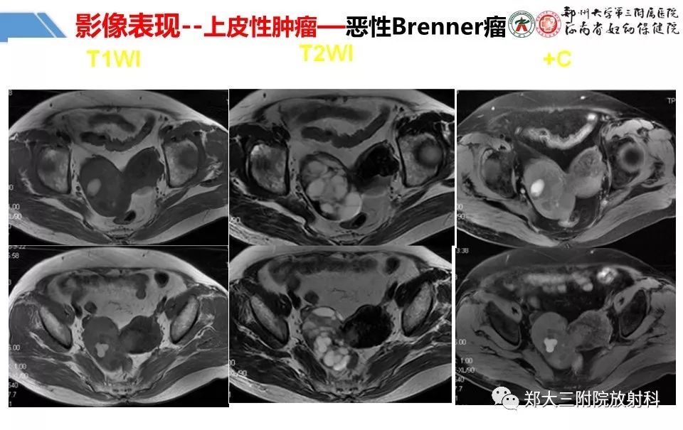 【PPT】卵巢肿瘤的影像诊断思路